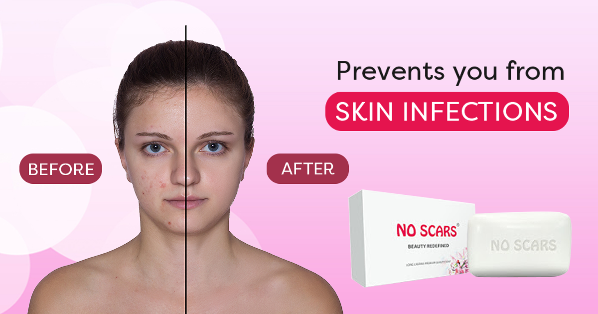 No scars soap and face wash is an effective treatment for scars