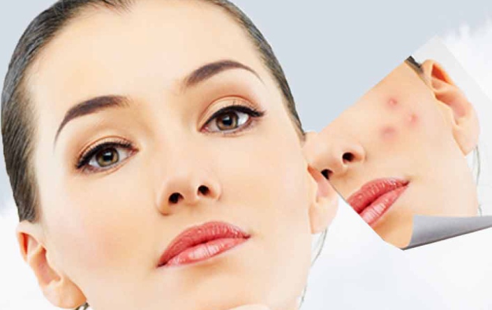 Treatment Of Acne Scars Help You In Getting Rid Of Deep Scars