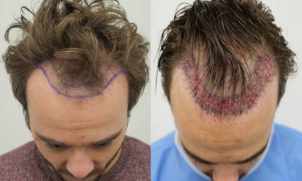 What Are The Needs To Choose Hair Transplant In Ludhiana?